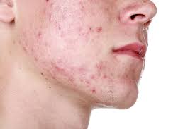 skin acne