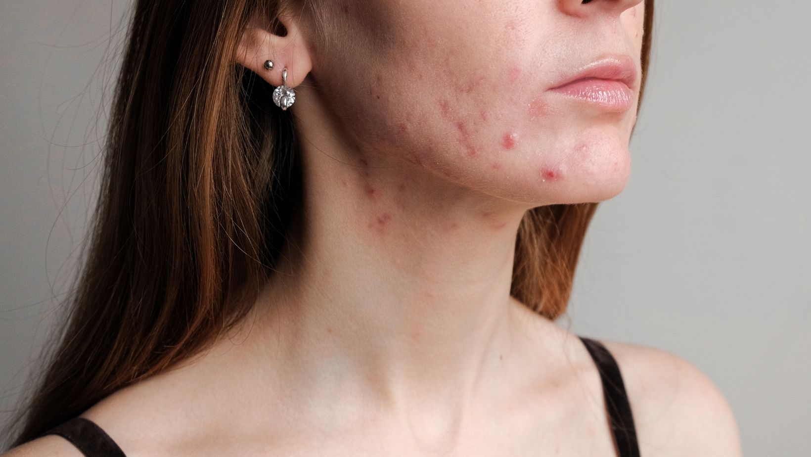 woman with hormonal acne on her face