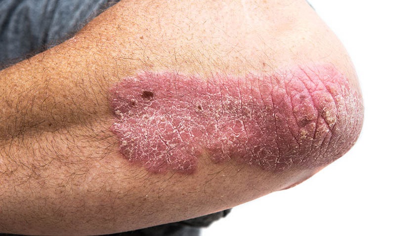 treat psoriasis at home