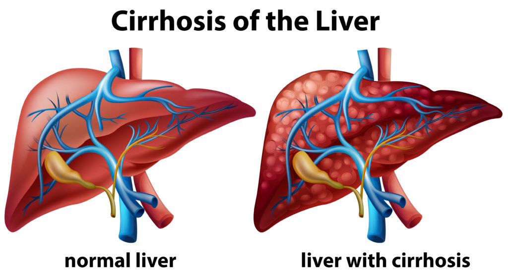 liver cirrhosis diagram