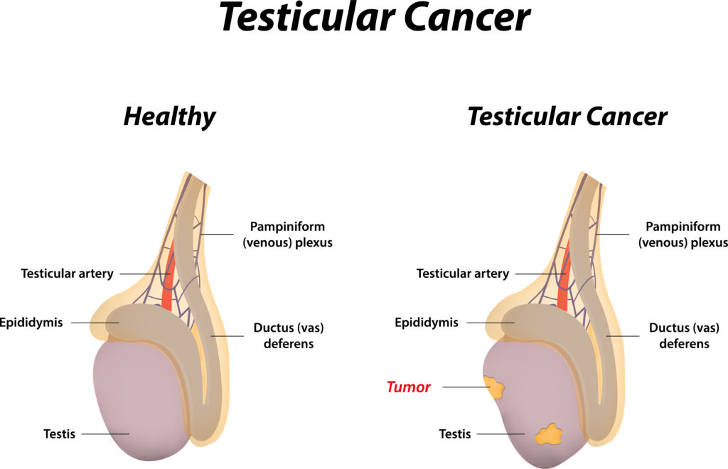  testicular cancer diagram