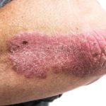 treat psoriasis at home